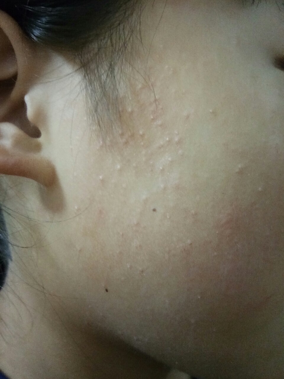 小孩脸上长这么多小疙瘩怎么弄呀?要不要紧?